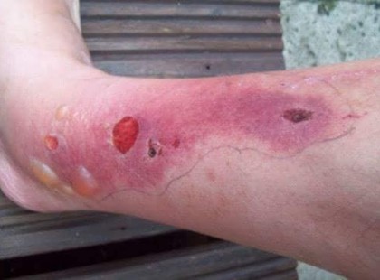 Figyelem!Mérgező növény terjed hazánkban,ami komoly égési sérüléseket okoz!!! Megkérlek, küldd tovább barátoknak, ismerősöknek!