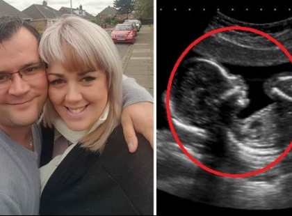 Majdnem elájultak a doktorok!Ezt fedezték fel a méhében