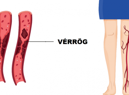 A vérrög 10 korai figyelmeztető jele, amit soha nem szabad figyelmen kívül hagyni