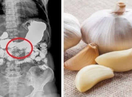 Ez történik , ha éhgyomorra fokhagymát eszel