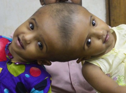 Szétválasztották a fejüknél összenőtt ikreket a Magyar orvosok. Világszinten elismerésre méltó