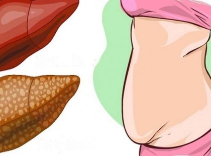 Ez a májzsírosodás ellen a leghatékonyabb “fegyver”