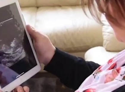 Hajat és fogakat találtak a méhében, először az orvosok se tudták, kinek a maradványai vannak a nőben