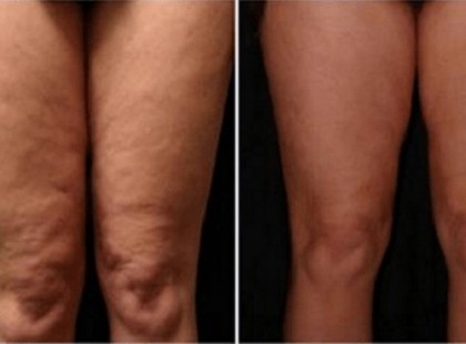 Amit a lábára kent, az neked is van otthon, csak nem jutott eszedbe