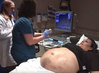 Terhes nőnek a hasa teli volt zúzódásokkal. Aztán az ultrahangra néztek, és kiderült mi történt