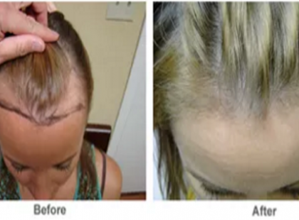 Ott nő a kertedben, és nem tudod, hogy visszafordítja a kopaszodást ez a növény!