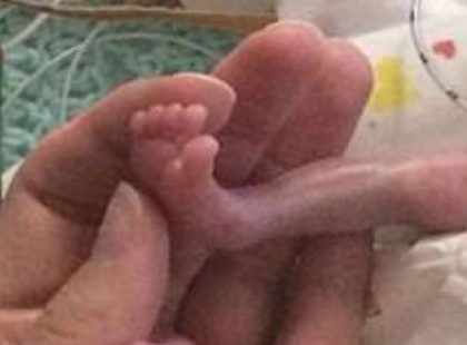 Senki sem hitte el hogy a 21 hetes baba életben marad – nézd hogy néz ki most