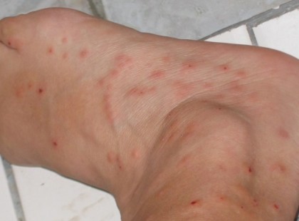 Vigyázat, egyre gyorsabban terjed a kórság! Ha ilyen foltot lát magán azonnal ellenőrizze az ágyát, könyveit, ruháit, függönyeit, szekrényeit, bőröndjeit! Otthon és idegen helyen is! Itt vannak a részletek