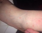 Villámgyorsan terjedő bőrkiütés ütötte fel a fejét – ha ilyen pöttyöket vagy foltokat fedezel fel magadon azonnal ellenőrizd az ágyadat, könyveidet, függönyeidet, szőnyegeket, szekrényeket, az összes ruhát és a bőröndöket is! Mutatjuk mit kell keresned :