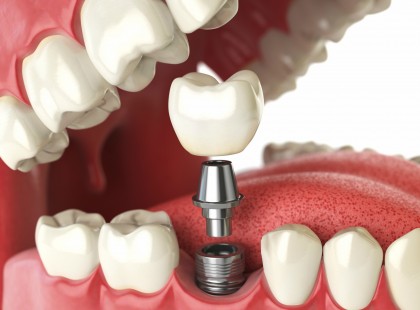 2020. JANUÁR 1-TŐL életkortól függetlenül jár a fogpótlásra az állami támogatás! 62 év alatt és 62 év felett is jár!!! Rengeteg pénzt jelent, ne hagyjuk veszni! Cseréltessük ki fogainkat ah szükség van rá! >>>