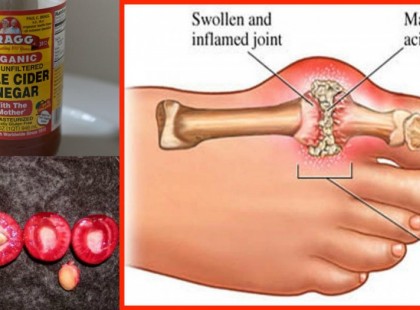 Oldd ki a húgysavat a végtagjaidból! Megújul minden, megszűnik az ízületi kín!