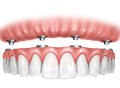HÉTFŐTŐL MÁR életkortól függetlenül jár a fogpótlásra az állami támogatás! 62 év alatt és 62 év felett is jár!!! Rengeteg pénzt jelent, ne hagyjuk veszni! Cseréltessük ki fogainkat ah szükség van rá! >>>