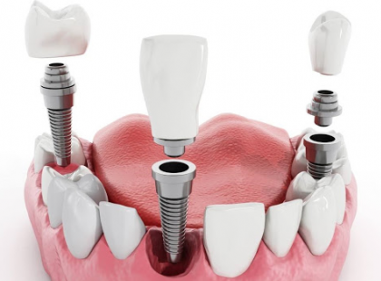 ÉLJEN!! MOSTANTÓL életkortól függetlenül jár a fogpótlásra az állami támogatás! 62 év alatt és 62 év felett is jár!!! Rengeteg pénzt jelent, ne hagyjuk veszni! >>>