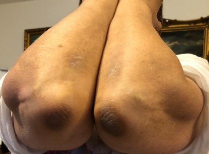 Könyökök ilyen elváltozása vagy vastagbél rák elötti, vagy már rákos állapot!