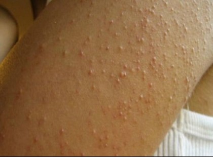 A „csendes gyilkos”, ami akár több ezer magyar embert is érinthet!