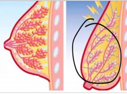 Ez a valódi oka a mellek megereszkedésének és mutatjuk mit tehetsz ellene!