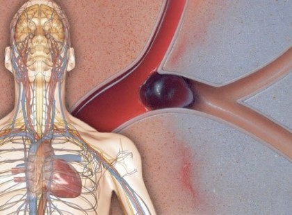 HA EZEKET A TÜNETEKET TAPASZTALOD AKKOR GYORSAN MENJ KÓRHÁZBA ! A „csendes gyilkos”, ami akár több tízezer magyar embert is érinthet!HA EZEKET A TÜNETEKET TAPASZTALOD AKKOR GYORSAN MENJ KÓRHÁZBA !