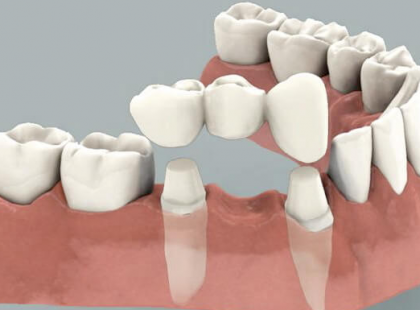 ÁLLAMI FOGÁSZATI TÁMOGATÁS JÁR MOSTANTÓL életkortól függetlenül a fogpótlásra! 62 év alatt és 62 év felett is jár!!! Rengeteg pénzt jelent, ne hagyjuk veszni! >>>