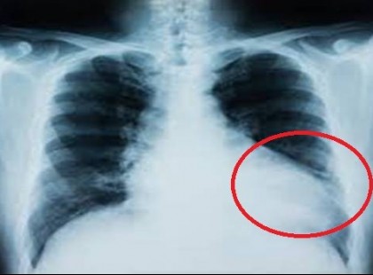 Vigyázat!!! Új tüdőbetegség pusztít a magyarok körében! Reggeli krákogással kezdődik az új halálos betegség! Veszélyesebb és alattomosabb, mint a tüdőrák!!!! Ezek a tünetek :