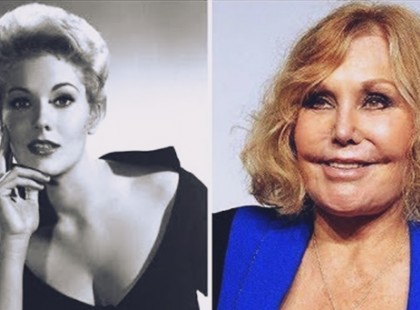 15 élő szörnyeteggé plasztikázott sztárok műtét előtt és után