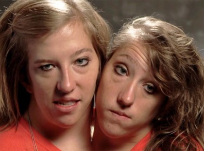 29 évesek lettek a sziámi ikrek! Most döbbenetes bejelentést tettek