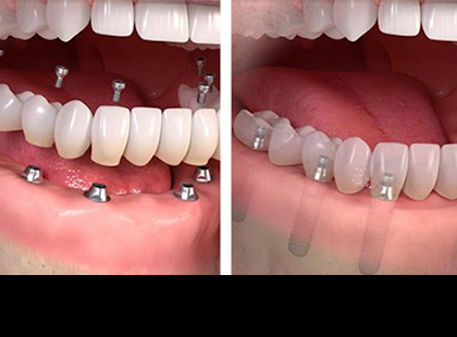 2020. OKTÓBER 12-én MÁR igényelhető!!!! >>> FOGTECHNIKAI DÍJRA ÉS FOGORVOSI MUNKADÍJRA IS JÁR AKÁR 100 %-OS TÁMOGATÁST! HIVATALOS tájékoztató a NEAK-tól! MUTATJUK HOGYAN IGÉNYELHETŐ!