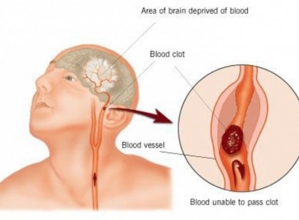 Még senki nem hallott a Stroke egyik legfontosabb előjeléről! Te legyél okosabb!