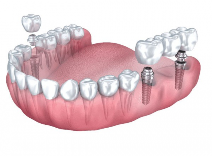 JÚLIUS 20-TÓL MÁR igényelhető!!!! >>> FOGTECHNIKAI DÍJRA ÉS FOGORVOSI MUNKADÍJRA IS JÁR AKÁR 100 %-OS TÁMOGATÁST! HIVATALOS tájékoztató a NEAK-tól! MUTATJUK HOGYAN IGÉNYELHETŐ!