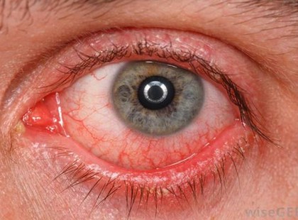 Új szokatlan tünetet azonosítottak – A koronavírusról árulkodik a szemünk is