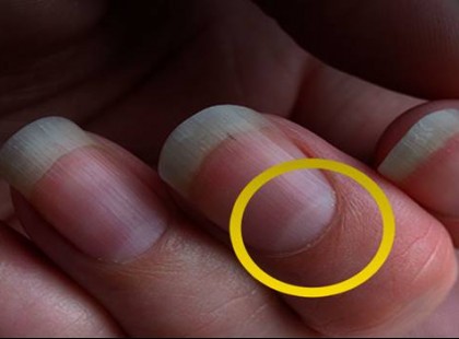 Mindenki azt hiszi a vitaminhiány jele, pedig súlyos betegség előjele a körmödön lévő folt