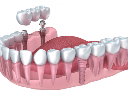 FEBRUÁR 1-TŐL MÁR igényelhető!!!! >>> FOGTECHNIKAI DÍJRA ÉS FOGORVOSI MUNKADÍJRA IS JÁR AKÁR 100 %-OS TÁMOGATÁST! HIVATALOS tájékoztató a NEAK-tól! MUTATJUK HOGYAN IGÉNYELHETŐ!