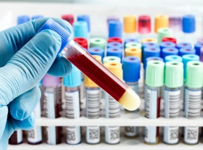 ÉLETBEVÁGÓ! Labor, vérvétel, vizeletvizsgálat! Erről tudj FELTÉTLENÜL , ha 2021. FEBRUÁR 1. után kell menned VÉRVÉTELRE, LABORBA! :