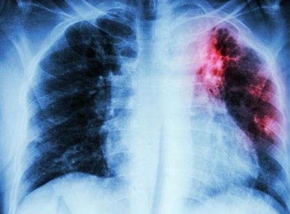 Vigyázat!!! Új tüdőbetegség pusztít a magyarok körében! Reggeli krákogással kezdődik az új halálos betegség! Veszélyesebb és alattomosabb, mint a tüdőrák!!!! Ezek a tünetek :