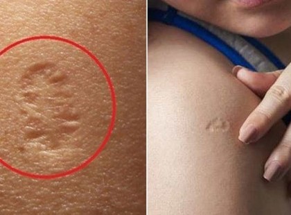 Te is kaptál ilyet? Ha neked is meg van ennek a védőoltásnak a helye, most nagyon figyelj!