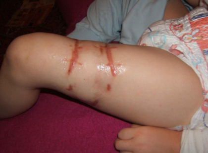 Pokoli tragédia! A 7 éves kisfiúnkat Eriket megtámadta egy kóbor kutya és Ezt a szörnyűséget művelte vele - Hatalmas szüksége van a segítségetekre! Könyörgöm Osszátok!