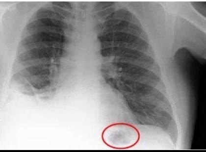 Felvágták a férfit, hogy kiszedjék a tüdejéből a tumort, de amit helyette találtak, azt elképzelni sem lehetett