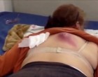 Már annyira fájt a háta, hogy elment vele inkább egy orvoshoz! A doki szinte rosszul lett, amikor a páciens felhúzta a pulóverét!