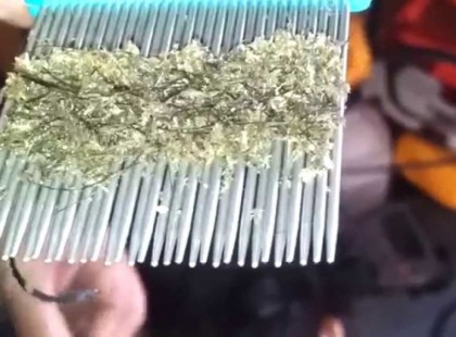 Ez nagyon félelmetes! EZT találták a mindössze hétéves gyerek hajában! Gyomorforgató látvány, csak erős idegzetűeknek!-videó