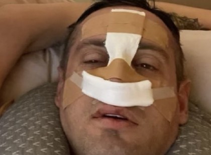 Szegedi Fecsó és párja, Bea Bekötözött fejjel, felduzzadt arccal jelentkezett a közösségi oldalán ,ez történt velük .