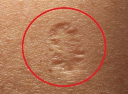 Ha van ilyen a bal kezén, az védett EZ ellen a komoly betegség ellen