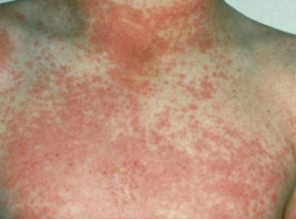 Szülők figyelem a skarlát visszatért – 5 figyelmeztető jel, amit soha nem szabad figyelmen kívül hagyni