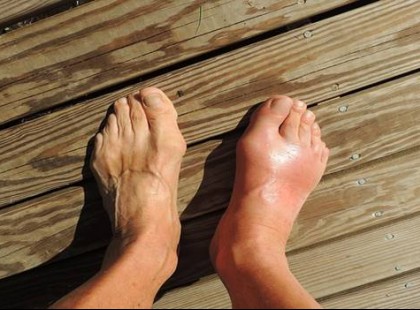 Így oldhatod ki gyorsan és termesztésen a húgysavat a testedből, hogy megszűnjön a köszvény és az ízületi fájdalom!