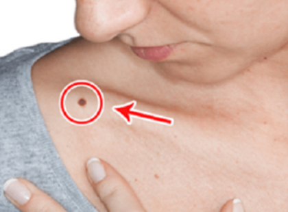 Nagyimtól tanultam ezért nincs szemölcs, barna folt, anyajegy a bőrömön sehol,nem is gondolnád miért...