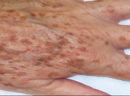 Amiről sokan nem tudnak: ezt jelzi valójában az öregedési folt