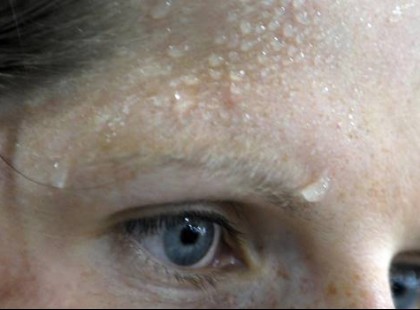 Ha azt hiszed a meleg miatt izzadsz, hatalmasat tévedsz! Ez a betegség áll a háttérben, ideje tudnod róla!