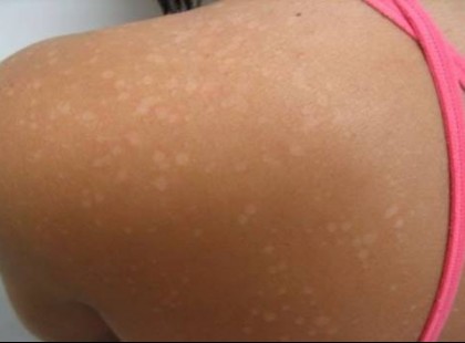 Neked is vannak fehér foltok a bőrödön? Ez áll a háttérben!