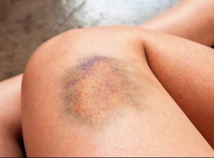 A vénás trombózis 6 jele, amit sok ember nem ismer fel idejében!