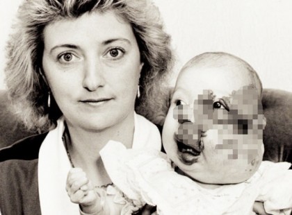 A kislány egy tumorral az arcán született – így néz ki 26 évvel később, a menyegzője napján