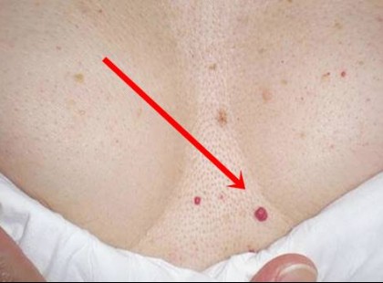 Rajtad is vannak ilyen piros pöttyök? Ha igen, akkor erről minél előbb tudnod kell!