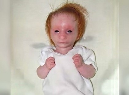 Játékbabára hasonlított, mikor megszületett. 5 teljes év telik el, és még az orvos sem hisz a szemének!